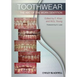 Toothwear: The ABC of the Worn Dentition
