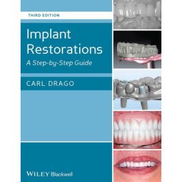 Implant Restorations: A Step-by-Step Guide