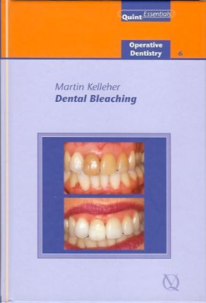 Dental Bleaching