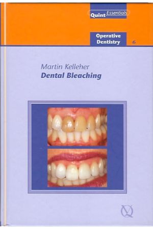 Dental Bleaching