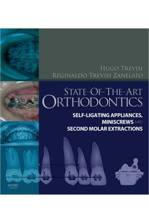 State-of-the-Art Orthodontics: Self-Ligating Appliances, Miniscrews and Second Molars Extraction