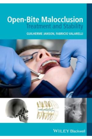 Open-Bite Malocclusion: Treatment and Stability