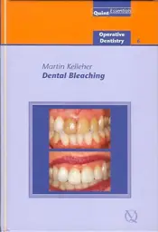 Dental Bleaching