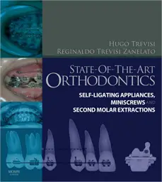 State-of-the-Art Orthodontics: Self-Ligating Appliances, Miniscrews and Second Molars Extraction