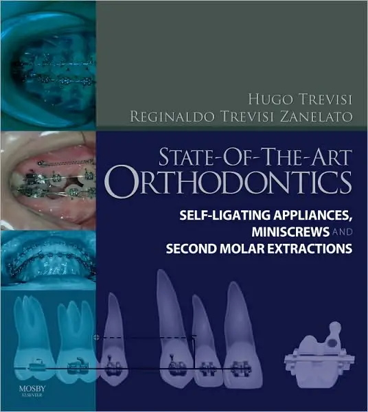 State-of-the-Art Orthodontics: Self-Ligating Appliances, Miniscrews and Second Molars Extraction