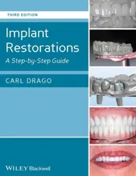 Implant Restorations: A Step-by-Step Guide