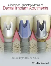 Clinical and Laboratory Manual of Dental Implant Abutments, 1st Edition